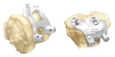 Patient Specific Knee replacement