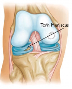 Meniscus Tear